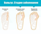 Косточка на ноге: почему происходит вальгусная деформация стопы